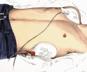 Position des électrodes